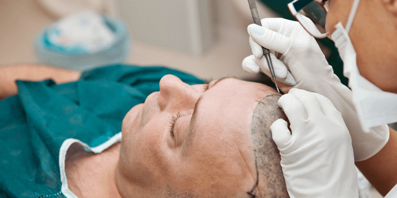 Beste haartransplantation türkei: Ein umfassender Leitfaden für Patienten