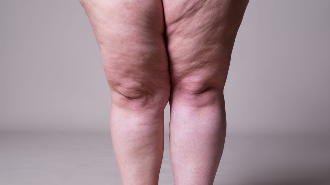 Schönheit neu definieren: Mit Lipödem Selbstliebe empfinden