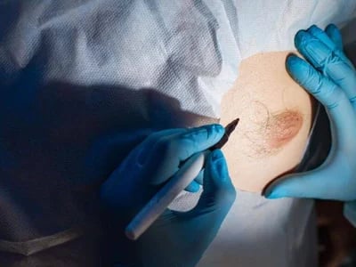 Brustvergrößerung mit Eigenfett: So funktioniert die gleichmäßige Fettverteilung