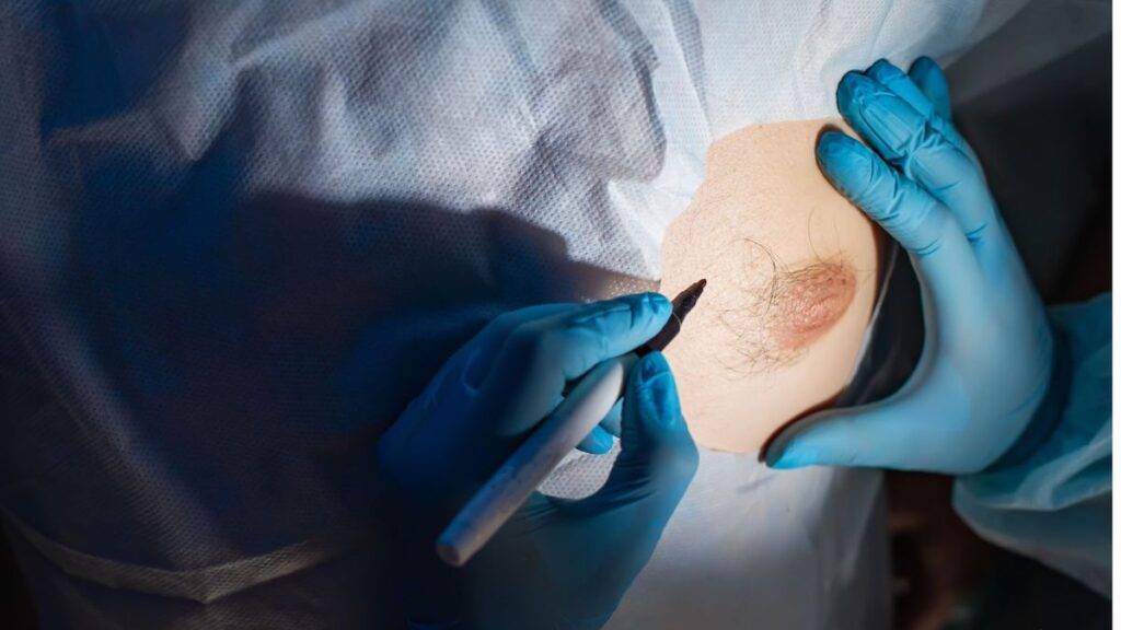 Brustvergrößerung mit Eigenfett: So funktioniert die gleichmäßige Fettverteilung